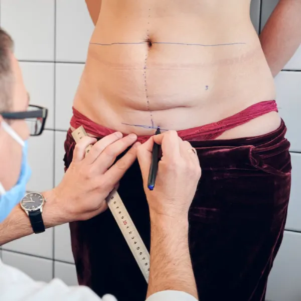 abdominoplastie